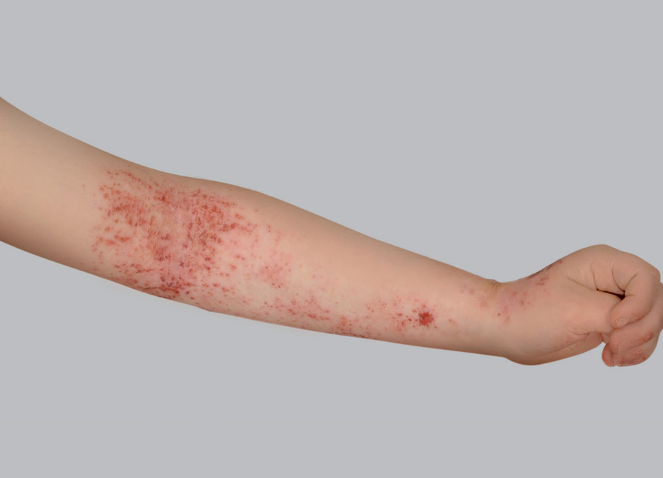 Understand eczema in children| Eczema Foundation